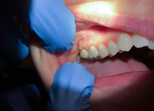 Best Emergency Tooth Extraction  in Lawnside, NJ